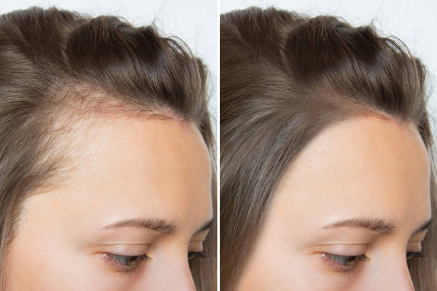 HairUp™ Crema para crecimiento del cabello